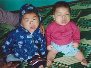 Amplias actividades de apoyo a víctimas vietnamitas del agente naranja